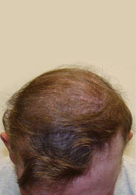 hair transplant photos