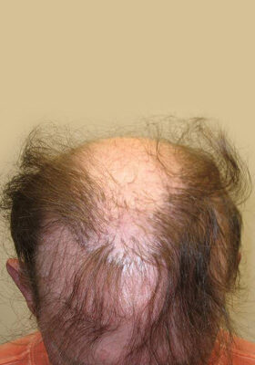 hair transplant photos