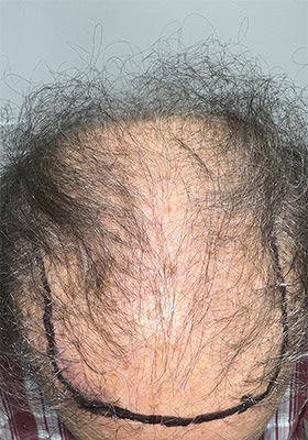 hair transplant before after Photos