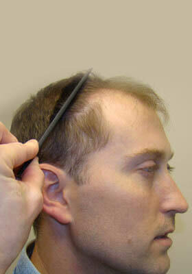 hair transplant photos