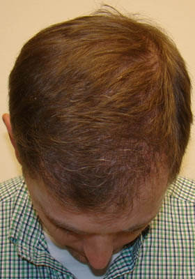 hair transplant before after Photos