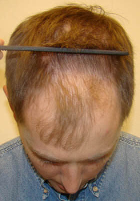 hair transplant photos