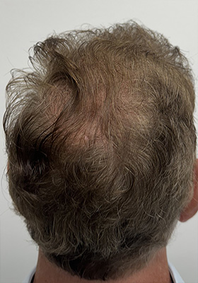 hair transplant photos