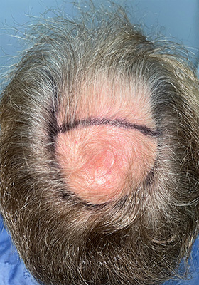 hair transplant photos