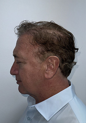hair transplant photos