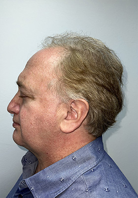 hair transplant photos
