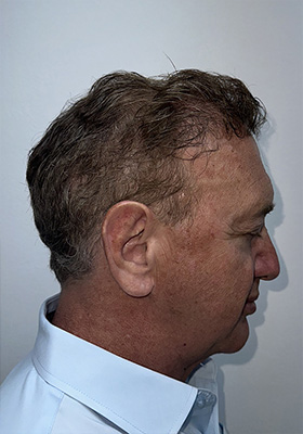 hair transplant photos