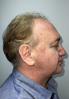 hair transplant photos