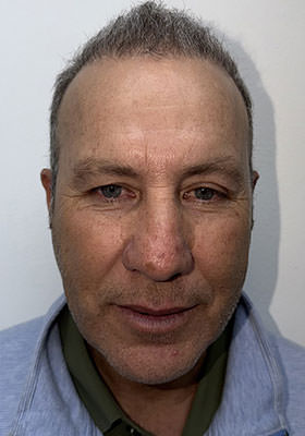 hair transplant photos