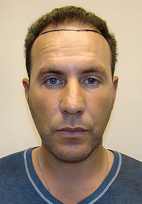 hair transplant photos