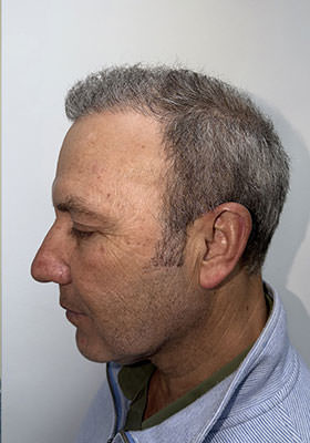 hair transplant photos