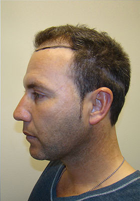 hair transplant photos