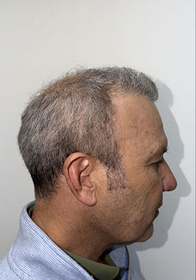 hair transplant photos