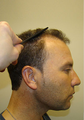 hair transplant photos