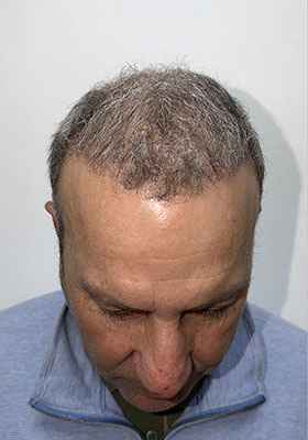 hair transplant photos