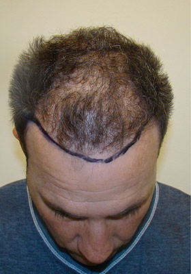 hair transplant photos