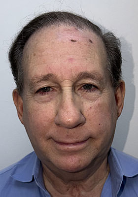 hair transplant photos