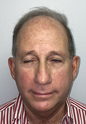 hair transplant photos