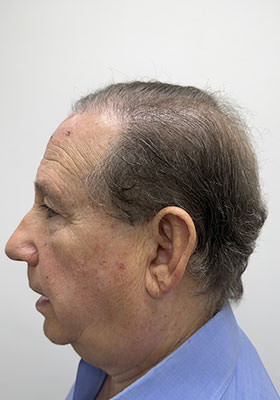 hair transplant photos