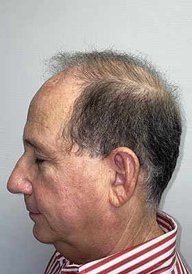hair transplant photos