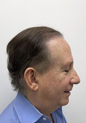 hair transplant photos