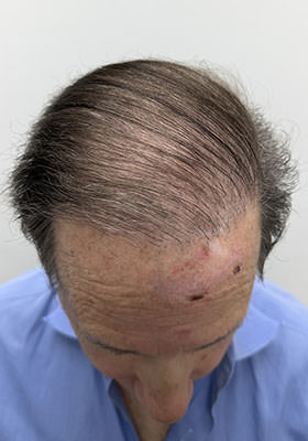hair transplant photos