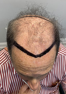 hair transplant photos