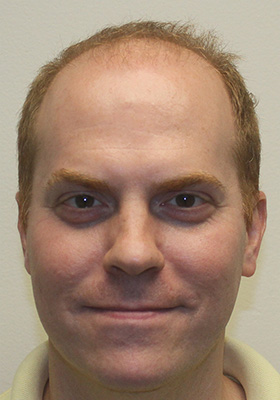 hair transplant photos