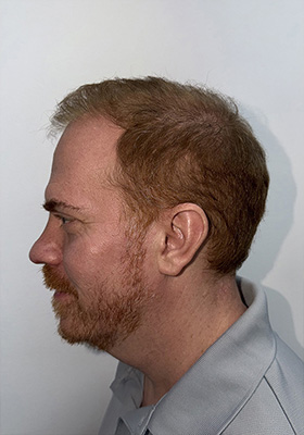 hair transplant photos