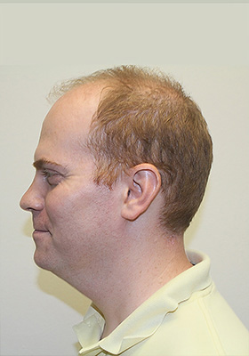 hair transplant photos