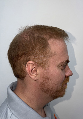 hair transplant photos