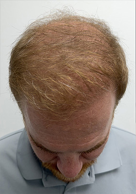 hair transplant photos