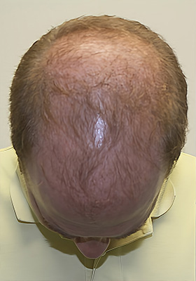 hair transplant photos
