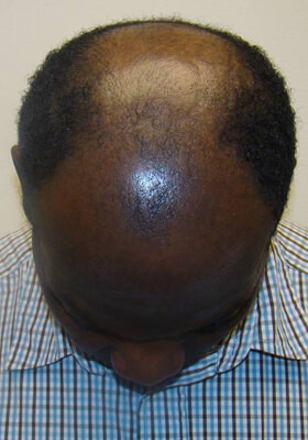 hair transplant before after Photos