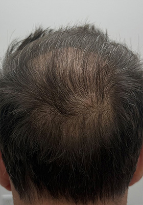 hair transplant photos
