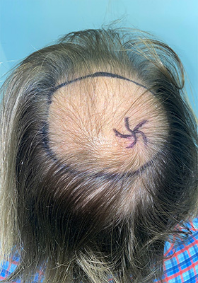 hair transplant photos
