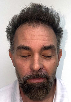 hair transplant photos