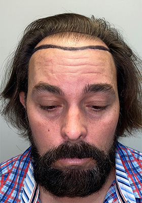 hair transplant photos