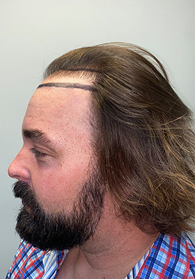 hair transplant photos