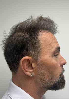 hair transplant photos