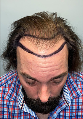 hair transplant photos