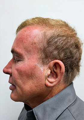 hair transplant photos