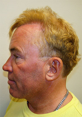 hair transplant photos