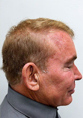 hair transplant photos