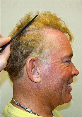 hair transplant photos