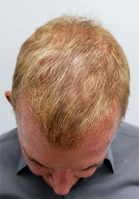 hair transplant photos