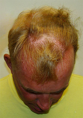 hair transplant photos