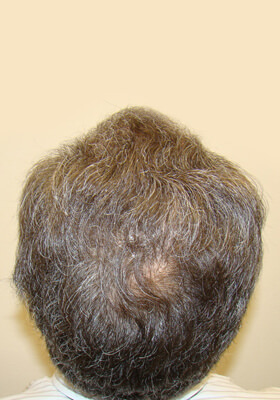 hair transplant photos