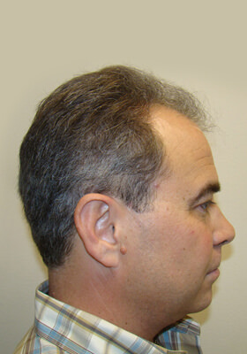 hair transplant photos