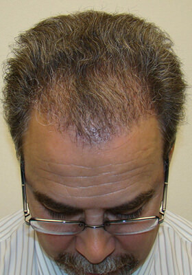 hair transplant photos